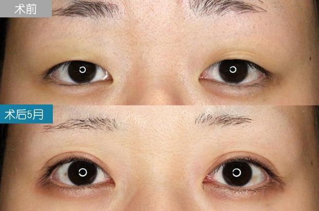 圣心美容丁奕如醫(yī)生解析:想要get自然的日式雙眼皮,需要注意哪幾點?