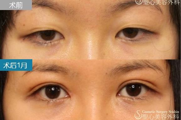 圣心美容丁奕如醫(yī)生解析:想要get自然的日式雙眼皮,需要注意哪幾點?