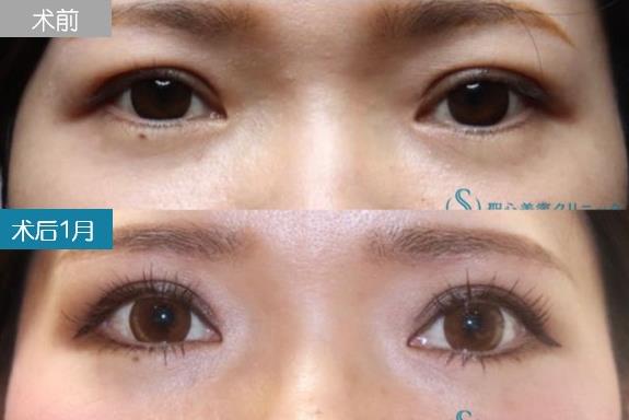 圣心美容丁奕如醫(yī)生解析:想要get自然的日式雙眼皮,需要注意哪幾點?