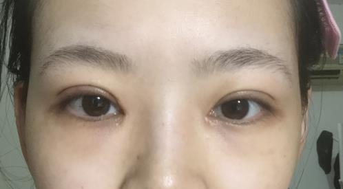 修志夫割雙眼皮的真實經(jīng)歷分享——莎吉特雙眼皮帶給我的蛻變!