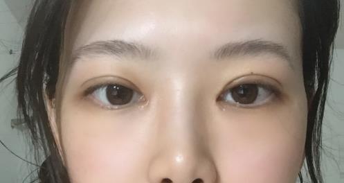修志夫割雙眼皮的真實經(jīng)歷分享——莎吉特雙眼皮帶給我的蛻變!
