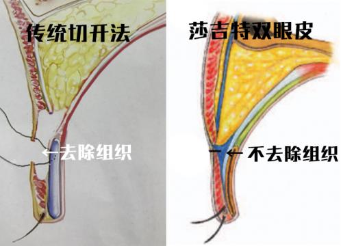 修志夫割雙眼皮的真實經(jīng)歷分享——莎吉特雙眼皮帶給我的蛻變!