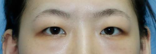 修志夫割雙眼皮的真實經(jīng)歷分享——莎吉特雙眼皮帶給我的蛻變!