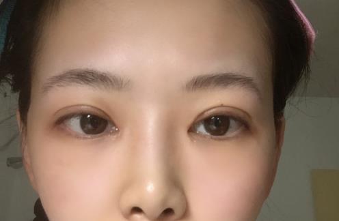 修志夫割雙眼皮的真實經(jīng)歷分享——莎吉特雙眼皮帶給我的蛻變!