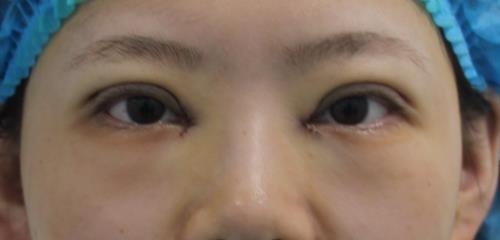 修志夫割雙眼皮的真實經(jīng)歷分享——莎吉特雙眼皮帶給我的蛻變!