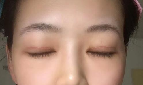 修志夫割雙眼皮的真實經(jīng)歷分享——莎吉特雙眼皮帶給我的蛻變!