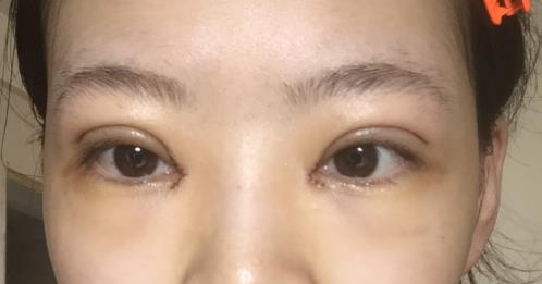 修志夫割雙眼皮的真實經(jīng)歷分享——莎吉特雙眼皮帶給我的蛻變!