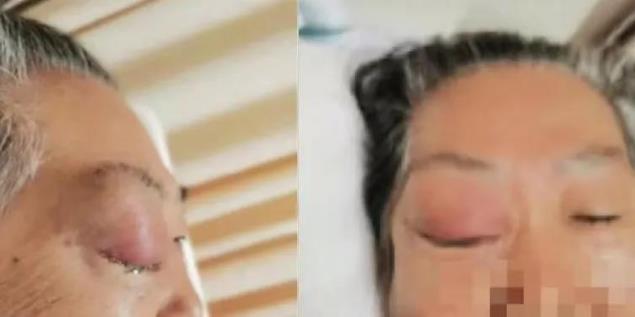高博醫(yī)療集團(tuán)北京博仁醫(yī)院胡凱主任:一例高齡復(fù)發(fā)難治彌漫大B細(xì)胞淋巴瘤患者的綜合治療