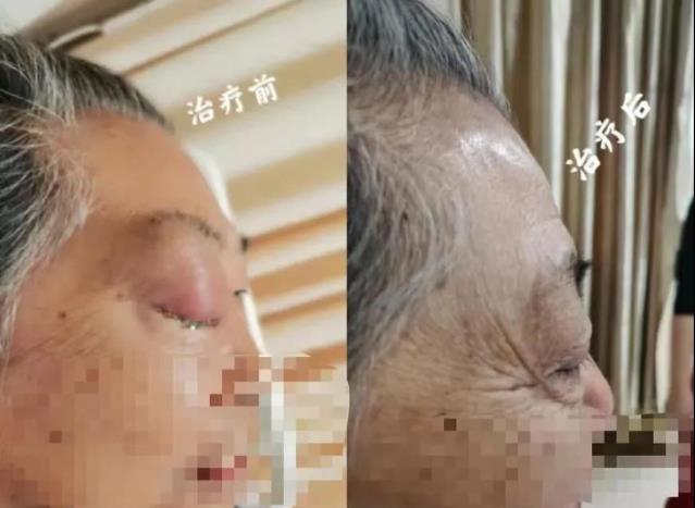 高博醫(yī)療集團(tuán)北京博仁醫(yī)院胡凱主任:一例高齡復(fù)發(fā)難治彌漫大B細(xì)胞淋巴瘤患者的綜合治療