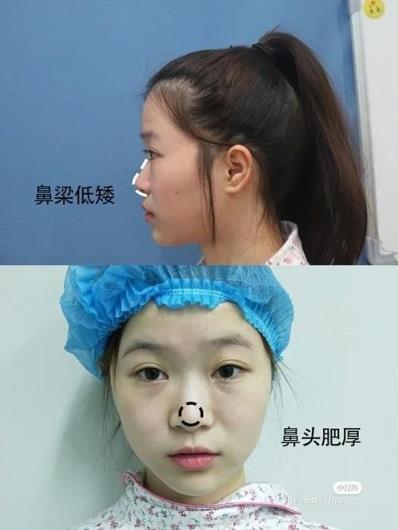 謝謝福州愛美爾朱剛強(qiáng)院長給做的鼻綜合,術(shù)后30天美美噠_點(diǎn)擊查看我的恢復(fù)情況