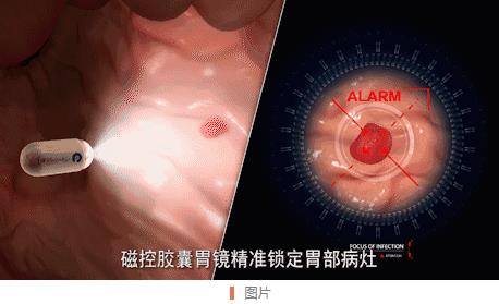 南寧東大醫(yī)院這顆電子膠囊胃鏡作用太奇妙,再也不用怕胃鏡檢查~
