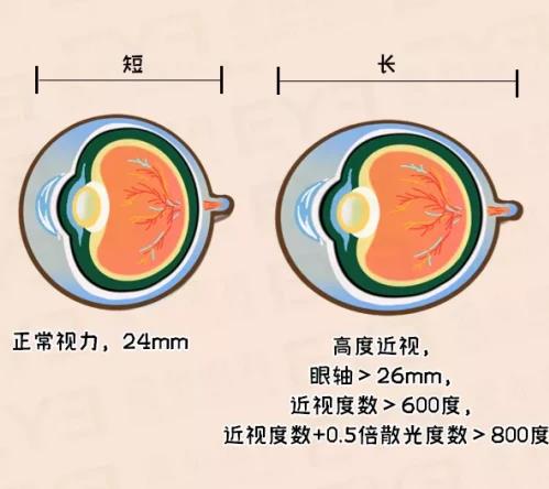 愛(ài)爾眼科怎么樣?近視>600度的人,此文必看