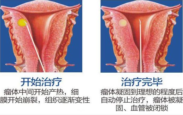 呼市五洲醫(yī)院婦科技術(shù)怎么樣BBT自凝刀治療子宮肌瘤不住院保子宮