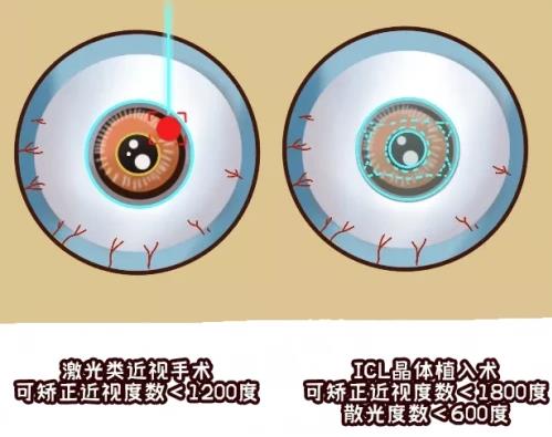 愛(ài)爾眼科怎么樣?近視>600度的人,此文必看