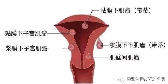 呼市五洲醫(yī)院婦科技術(shù)怎么樣BBT自凝刀治療子宮肌瘤不住院保子宮