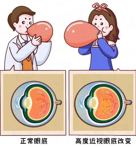 愛(ài)爾眼科怎么樣?近視>600度的人,此文必看
