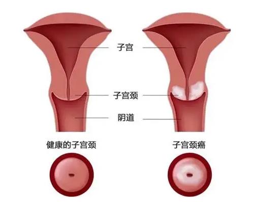 HPV潛伏期長(zhǎng)陰難 新科技新臺(tái)階康復(fù)之路迎曙光