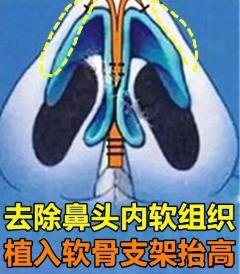 隆鼻再修復(fù) 高難度修復(fù) 美憬醫(yī)療修復(fù)基地 李炳澮教授