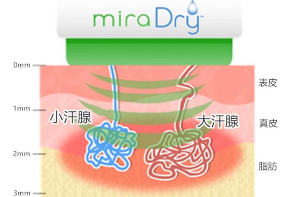 圣心美容高須淳司醫(yī)生解析:MiraDry清新微波治療腋臭多汗的原理和效果