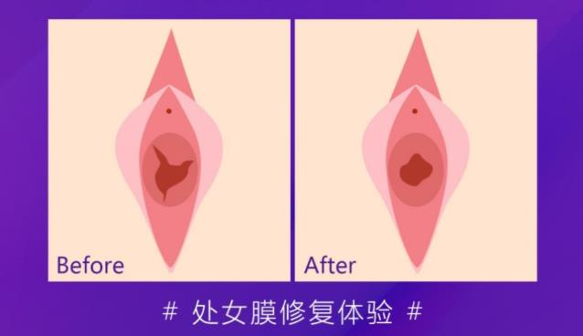 處女膜修復(fù)好以后會被看出來嗎,昆明美立方私密整形醫(yī)院處女膜修復(fù)