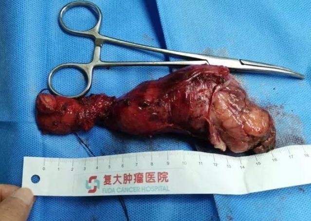 廣州好的腫瘤醫(yī)院在哪里暨南大學(xué)附屬復(fù)大腫瘤醫(yī)院