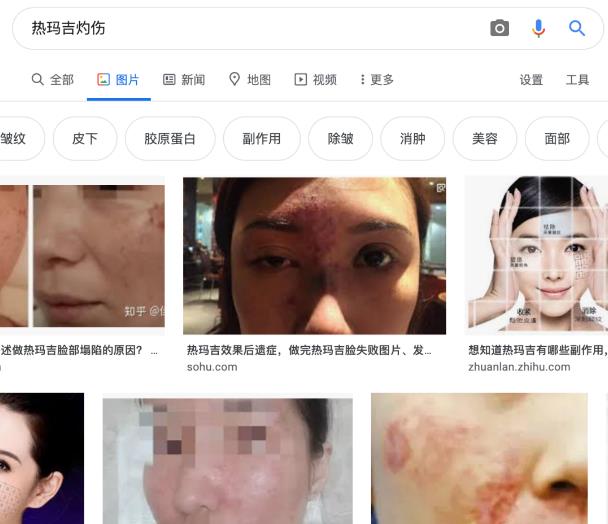 鄭州美萊整形醫(yī)院怎么樣 熱瑪吉抗衰 實現(xiàn)面部年輕化