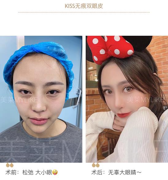 鄭州美萊整形醫(yī)院靠譜嗎 資質(zhì)齊全 技術(shù)可靠暑期變美必做整形項目