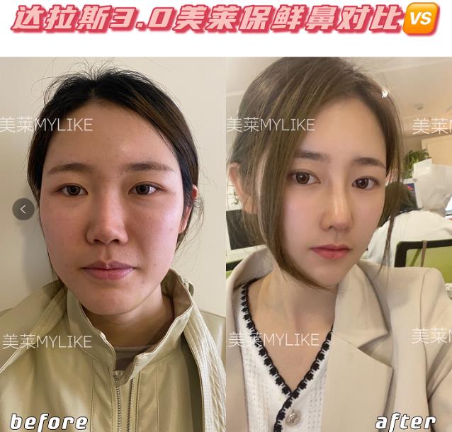 鄭州美萊整形醫(yī)院靠譜嗎 資質(zhì)齊全 技術(shù)可靠暑期變美必做整形項目