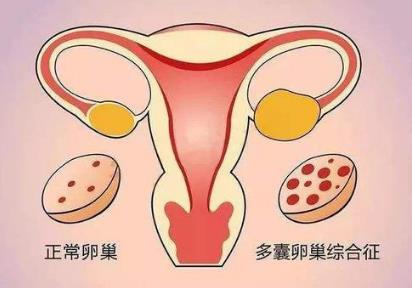 新陽光生殖健康研究中心多囊卵巢綜合癥要怎么檢查?