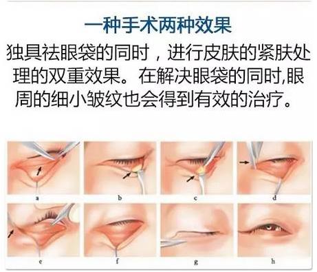 眼袋是怎么形成的,沈陽(yáng)杏林整形做眼袋多少錢