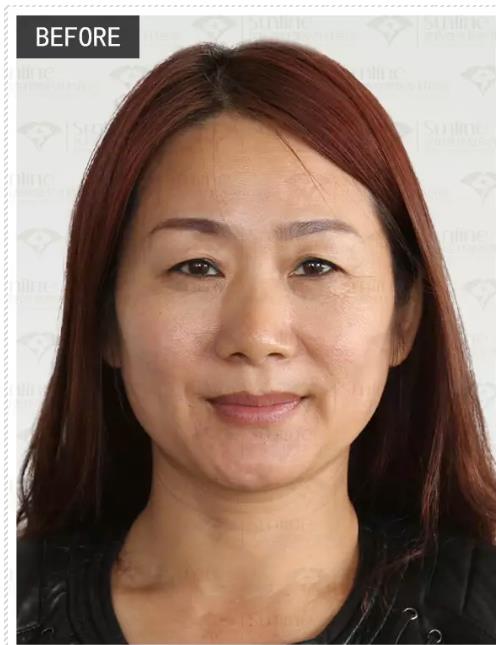 眼袋是怎么形成的,沈陽(yáng)杏林整形做眼袋多少錢