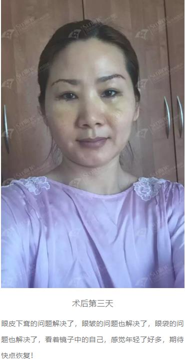 眼袋是怎么形成的,沈陽(yáng)杏林整形做眼袋多少錢