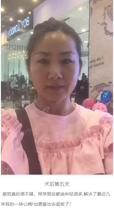 眼袋是怎么形成的,沈陽(yáng)杏林整形做眼袋多少錢