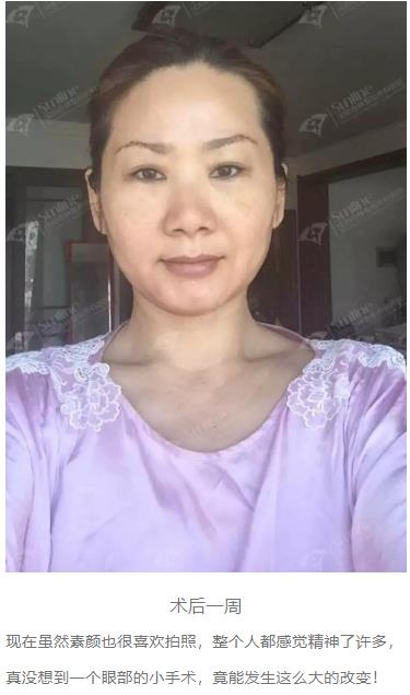 眼袋是怎么形成的,沈陽(yáng)杏林整形做眼袋多少錢