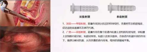 真閨蜜才會建議你做私密熱瑪吉!