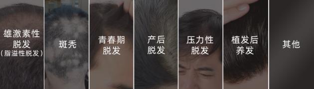 沐發(fā)舒藥浴乳帶你“禿”出重圍,擺脫脫發(fā)焦慮