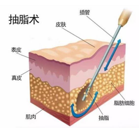 北京依一醫(yī)療美容武崇高醫(yī)生吸脂怎么樣 部位塑形,想瘦哪里都可以