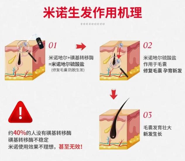 健絲俠新發(fā)現(xiàn):米諾地爾為什么沒有用?原來‘酶’才是關鍵!