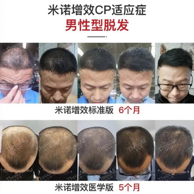 健絲俠新發(fā)現(xiàn):米諾地爾為什么沒有用?原來‘酶’才是關鍵!