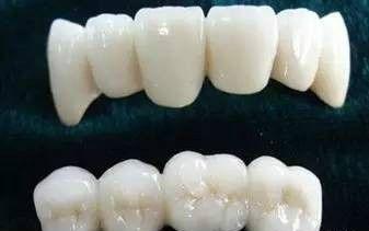 中家醫(yī)家庭醫(yī)生口腔 為什么口腔醫(yī)生讓你去選擇全瓷牙