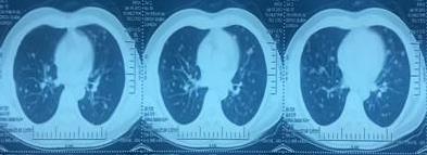 南寧腫瘤醫(yī)院推薦廣州復大腫瘤醫(yī)院:肺癌彌漫多處轉(zhuǎn)移