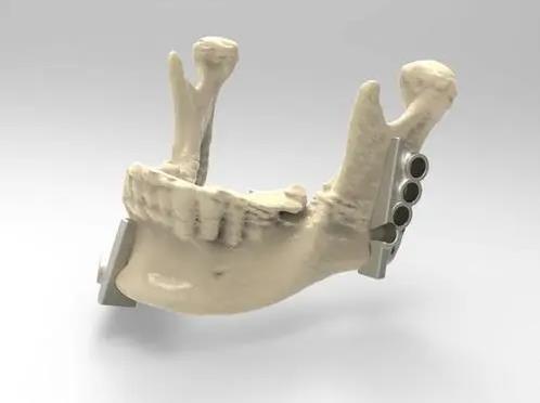 圣嘉新邱立東:3D導(dǎo)板技術(shù)在下頜成角截骨術(shù)中的應(yīng)用