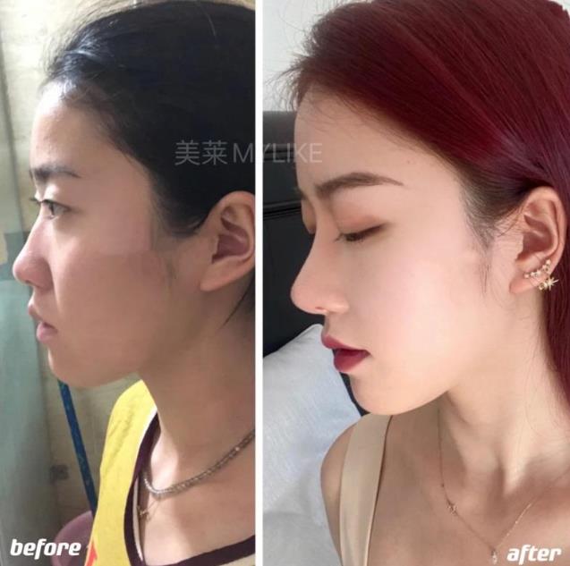 鄭州美萊醫(yī)院正規(guī)嗎 資質(zhì)齊全 正規(guī)可靠改善鼻部缺陷 打造立體美鼻