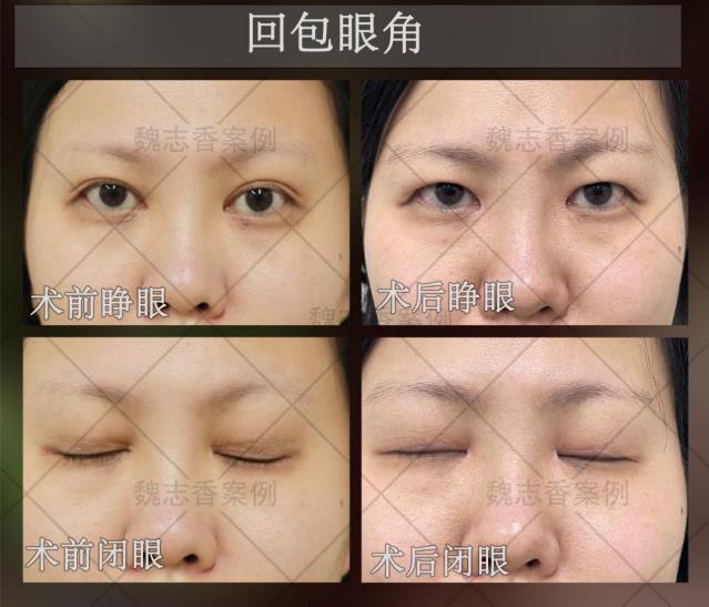 開了內(nèi)眼角過大要怎么修復(fù),魏志香是如何修復(fù)的呢?