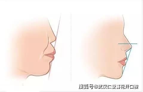 武漢仁愛口腔醫(yī)生告訴你寶寶替牙期千萬別吃軟食