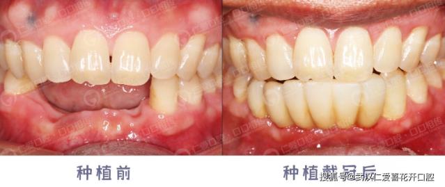 武漢仁愛口腔半口牙種植的優(yōu)勢,吃東西再也不費(fèi)勁