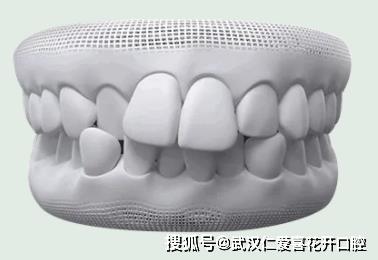 武漢仁愛(ài)口腔怎么樣?【真實(shí)案例】牙齒矯正,拯救你的臉!