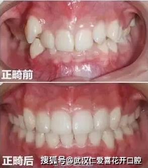 武漢仁愛(ài)口腔怎么樣?【真實(shí)案例】牙齒矯正,拯救你的臉!
