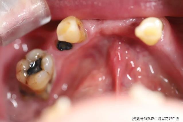 武漢仁愛(ài)口腔【種植案例】全口種植解決牙齒缺失,頗受患者好評(píng)!