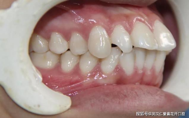 武漢仁愛(ài)口腔怎么樣?【真實(shí)案例】牙齒矯正,拯救你的臉!